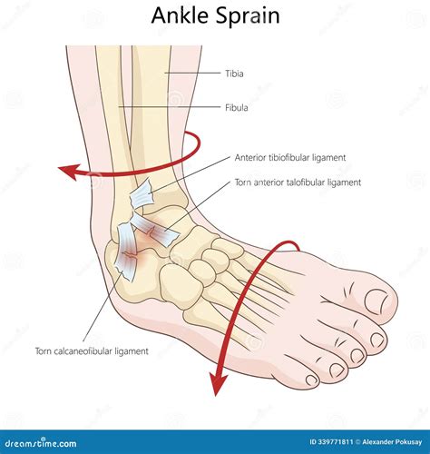 Ankle Sprain Diagram with Torn Ligaments Medical Stock Illustration ...