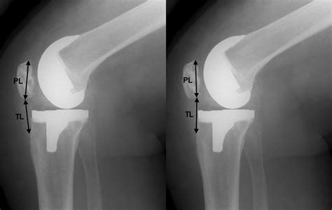 Knee Replacement Xray