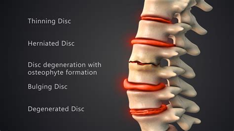 What is Degenerative Disc Disease? - Atlanta Brain and Spine Care