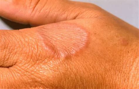 Diabetes & Hyperlipidemia Increase Risk of Development of Granuloma ...