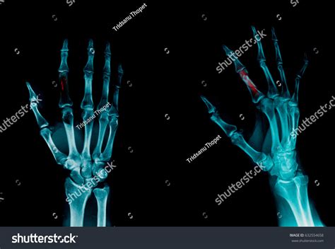 Xray Image Fracture Index Finger Stock Photo 632554658 | Shutterstock