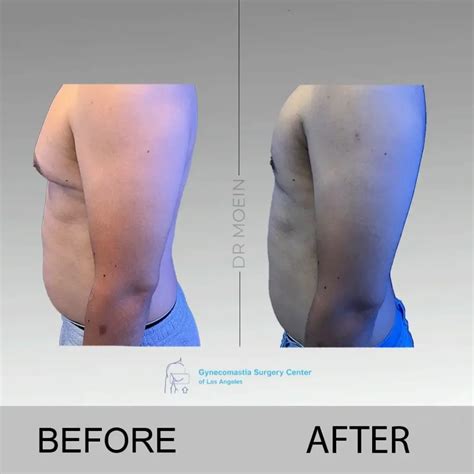 Shape the Chest After Gynecomastia Surgery in LA, CA | 2024