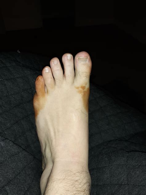 Brown spots appeared on my foot? : medical_advice