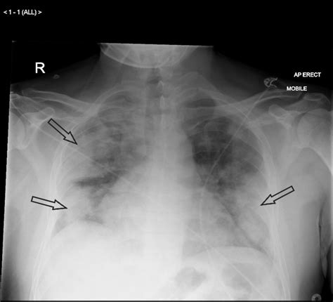 Can A Chest X Ray Show Pneumonia at Elizabeth Chow blog