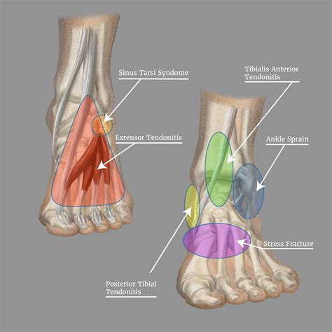 Back Of Ankle Pain at Charles Nunnally blog