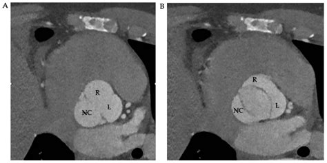 JCM | Free Full-Text | Patients with Bicuspid Aortopathy and Aortic ...