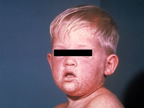 Mumps & Measles: What are the Risks? | MDcare4you