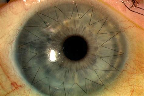 Corneal Transplants in Bangalore | Prasad Eye Hospital