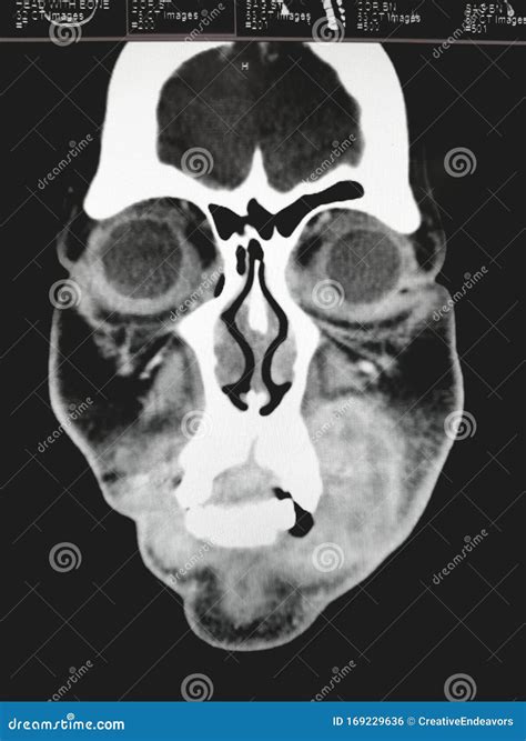 Coronal CT Scan of the Sinuses and Face Stock Photo - Image of healthy, machine: 169229636