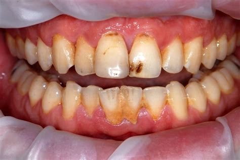 Image result for Stumpy Black Teeth