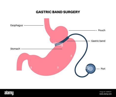Surgical Stomach Band