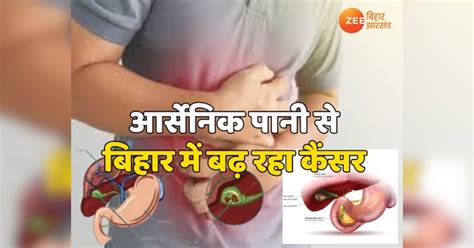 Gall Bladder Cancer is increasing in Bihar due to arsenic water of ...
