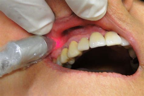 Low-Level Laser Therapy (LLLT) - Laxmi Dental Care