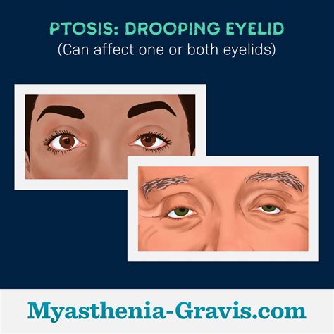 Common Symptoms of Myasthenia Gravis