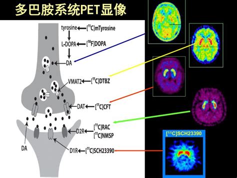 PPT - PET/CT 在退行性 脑 疾病的应用及进展 PET/CT in the Neurodegenerative disease 管一 ...