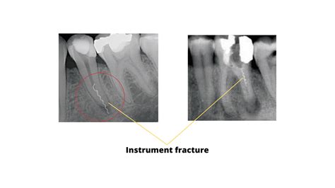 The telltale signs of failed root canal with X-ray pictures