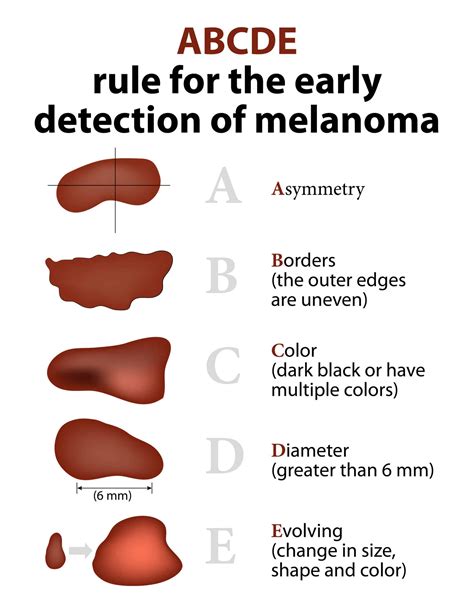 The mole guide: what does a cancerous mole look like? - Harley Medical Group