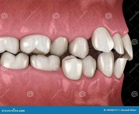 Image result for Contralateral Teeth