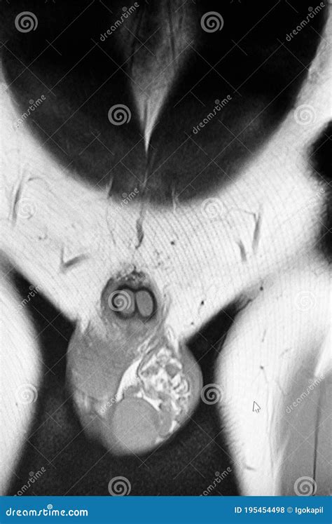 Pelvic Mri Diagnostic Varicocele Pathology Man Stock Photo - Image of ...