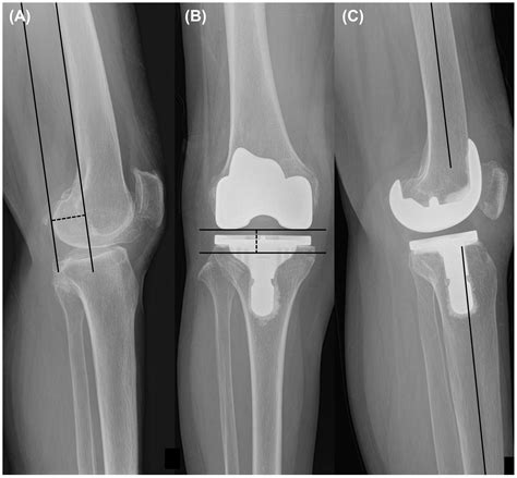 The Effect of Severe Varus Deformity on Clinical and Radiographic ...