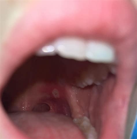 Canker Sore On Soft Palate Canker Sores: Causes, Symptoms, Treatment