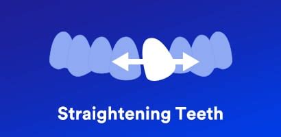 How Braces Work? | 3M India