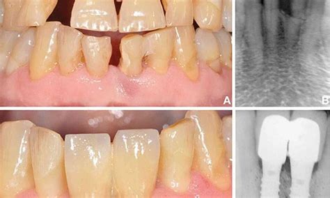Outcomes of Immediate implant placement in damaged extraction sockets ...