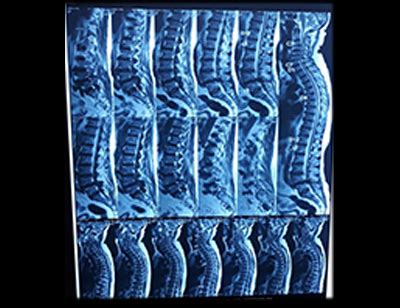 Dr. Vinod Gautam - Chipper Price For Spine Operation Doctor, Spine ...