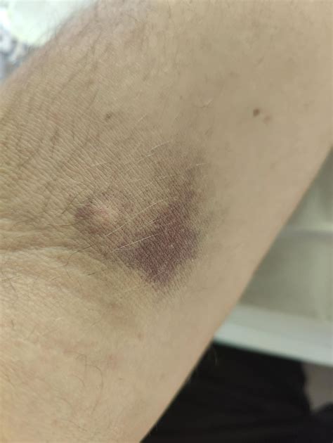 Panicking before donating? Blood pressure spike and pouring sweat. : r/Blooddonors