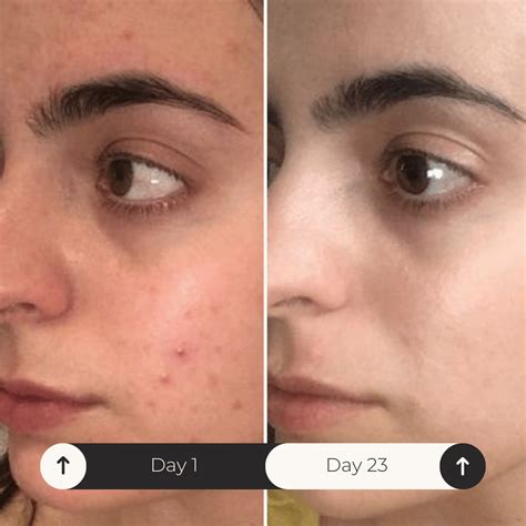 The Ultimate Multi-Active Skin Potion for All Skin Concerns – Skinvest