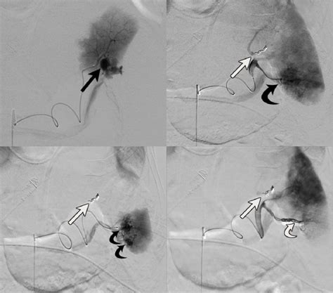 Table 1 from The Baltimore CT Severity Index (CTSI) versus the American ...