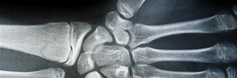 Image result for Soft Tissue Sarcoma Hand