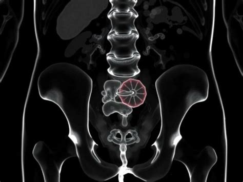 Image result for Psoas Sign Appendicitis