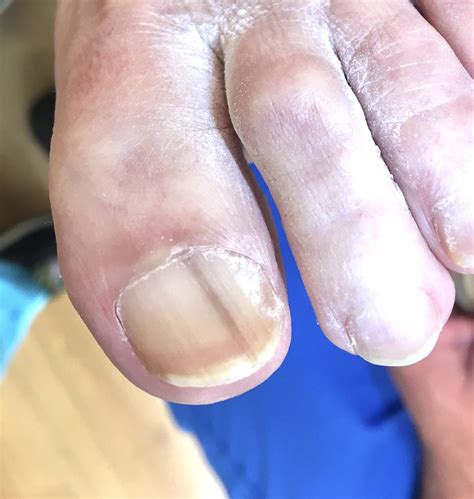 Black Longitudinal Toenail Line. Should I Worry? - Compleet Feet