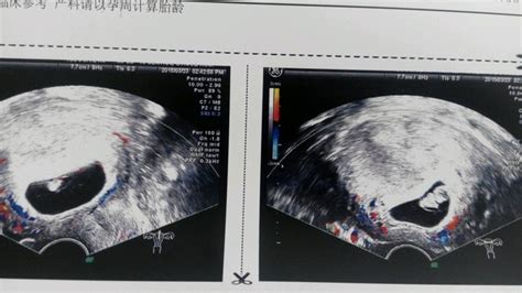 请问怀孕早期胎儿位置偏低会严重吗？我B超图显示的请问有没有问题呢？ - 百度宝宝知道