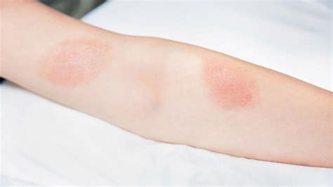 Signs Of Infection Wounds - University Urgent Care