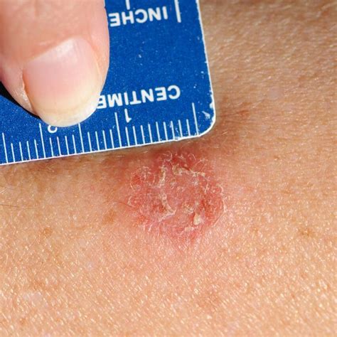 How to manage ringworm in babies and children | BabyCenter