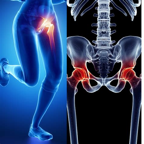 Hip Problem Pain 的图像结果