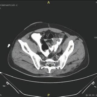 Image result for Distal Loopogram