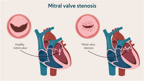 Mitral valve problems: signs, diagnosis and treatment - Guys and St ...