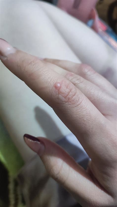 Bump on finger : r/AskDoctorSmeeee