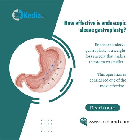 Endoscopic Sleeve Gastroplasty Vs Gastric Sleeve at Spencer Ebert blog
