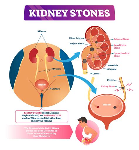 Kidney Stones Pain Location Women