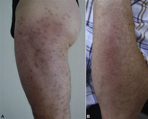 Expanding the clinicopathological spectrum of late cutaneous Lyme ...