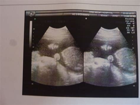 怀孕11周了，注（医生给算的）我月经每40天左右来一次月经 今天去医院拍片B超说看不到胎心和胎芽我 - 百度宝宝知道