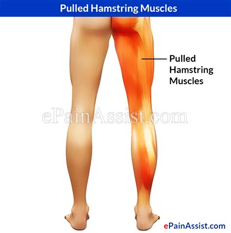 Pulled Hamstring Muscles - Epainassist - Useful Information for Better Health