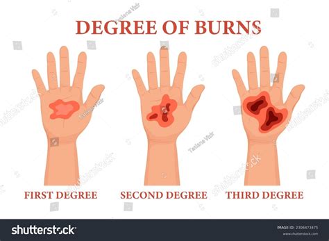 1st Degree Burn