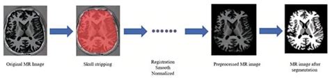 Deep Learning-Based Diagnosis Algorithm for Alzheimer’s Disease