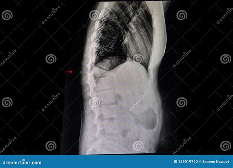 Compression Fracture of a Thoracic Spine Spine Stock Photo - Image of sick, anatomy: 129019740