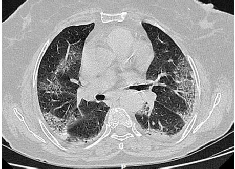 Fig. 3: Ground glass opacity (GGO) with septal thickening
